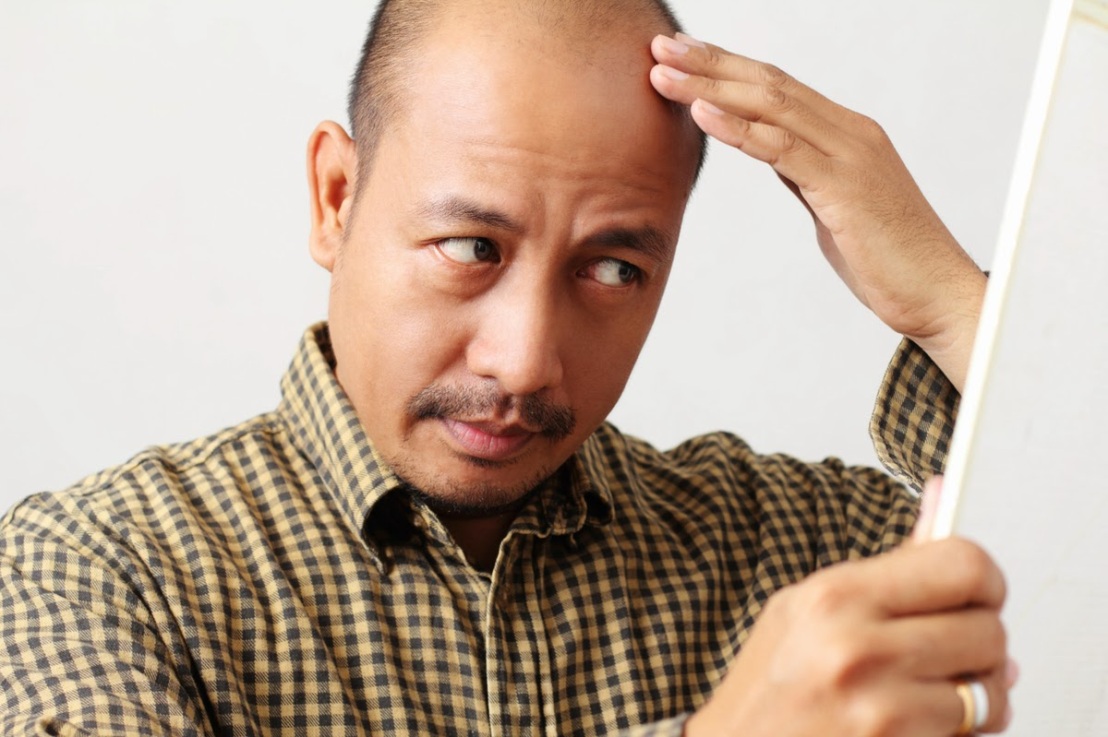Treating Male Pattern Baldness with Essential Oils